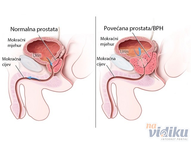 hipertenzija i prostate